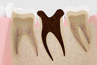 虫歯進行イメージ4